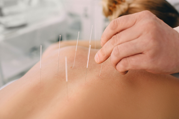 Les aiguilles d'acupuncteur doivent être stérilisées après chaque utilisation.